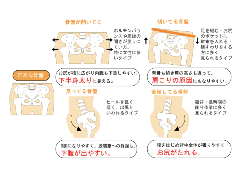 骨盤が歪む原因